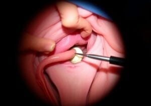 Hysteroscopic Surgery